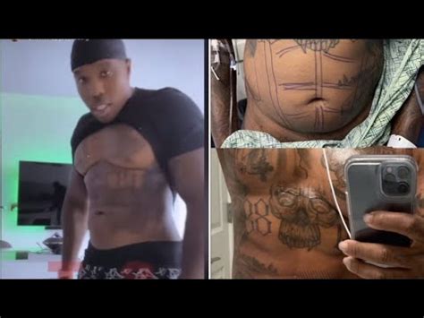 bandman kevo before and after surgery|Bandman Kevo Gets Liposuction for His Abs